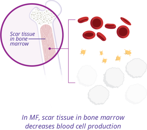 Three graphics showing – first- Normal blood cell production, 2nd In, MF, scar tissue decreases blood cell production, 3rd Spleen gets larger as it helps to produce blood cells