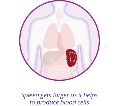 Three graphics showing – first- Normal blood cell production, 2nd In, MF, scar tissue decreases blood cell production, 3rd Spleen gets larger as it helps to produce blood cells