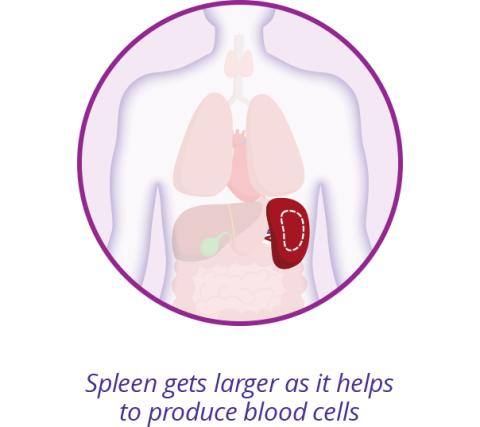 Three graphics showing – first- Normal blood cell production, 2nd In, MF, scar tissue decreases blood cell production, 3rd Spleen gets larger as it helps to produce blood cells