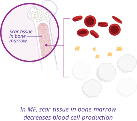 Graphic showing MF scar tissue decreases blood cell production